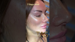 Transformative Facelift Experience with Dr. Tas: Unveiling Timeless Beauty