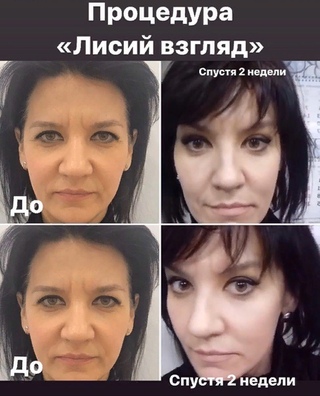 Операция лисий взгляд до и после АКАДЕМИЯ СТАНДАРТ ТЮМЕНЬ - МОДЕЛИ ВКонтакте
