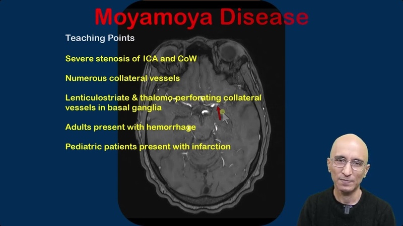 Moyamoya